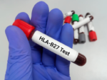 HLA-B27 FLOW CYTOMETRY