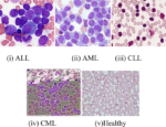 ACUTE LEUKEMIA DIAGNOSTIC COMPREHENSIVE PROFILE