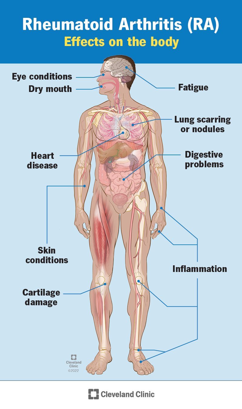 RHEUMATOID AUTOIMMUNE COMPREHENSIVE PANEL