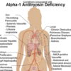 ALPHA-1-ANTITRYPSIN (AAT)