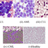 ACUTE LEUKEMIA DIAGNOSTIC COMPREHENSIVE PROFILE