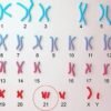 CHROMOSOME ANALYSIS (KARYOTYPE), BLOOD